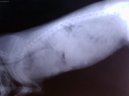 Onkologie - Novotvary ml��n� �l�zy u fen